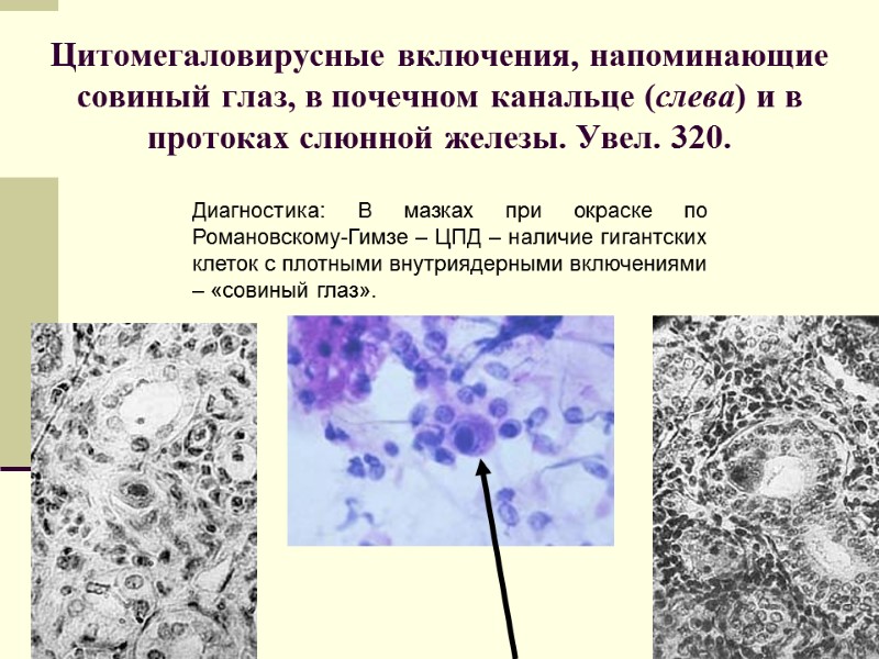Цитомегаловирусные включения, напоминающие совиный глаз, в почечном канальце (слева) и в протоках слюнной железы.